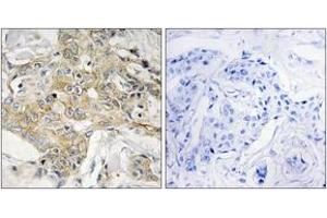 Immunohistochemistry analysis of paraffin-embedded human breast carcinoma tissue, using T4S1 Antibody. (TM4SF1 抗体  (AA 1-50))