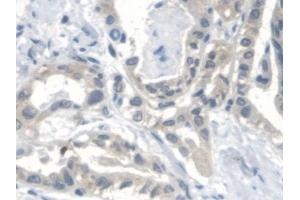 Detection of CTBS in Human Thyroid cancer Tissue using Polyclonal Antibody to Di-N-Acetyl Chitobiase (CTBS) (CTBS 抗体  (AA 47-385))
