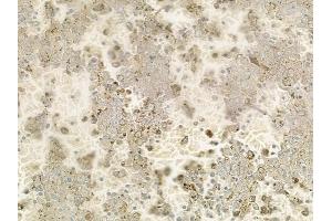 ABIN6257767 and ABIN6275463 at 1/100 staining human melanoma by IHC-P.