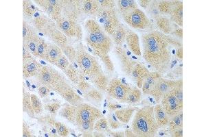 Immunohistochemistry of paraffin-embedded Human liver cancer using BLVRB Polyclonal Antibody at dilution of 1:100 (40x lens). (BLVRB 抗体)