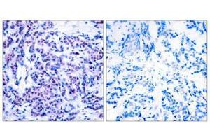 Immunohistochemical analysis of paraffin-embedded human breast carcinoma tissue using JunD(Phospho-Ser255) Antibody(left) or the same antibody preincubated with blocking peptide(right). (JunD 抗体  (pSer255))