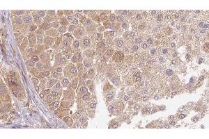 ABIN6272666 at 1/100 staining Human Melanoma tissue by IHC-P.