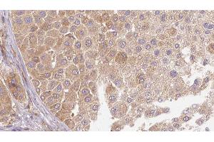 ABIN6272666 at 1/100 staining Human Melanoma tissue by IHC-P. (LTBP1 抗体  (C-Term))