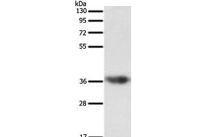 Western Blot analysis of Human liver cancer tissue using SULT1E1 Polyclonal Antibody at dilution of 1:500 (SULT1E1 抗体)