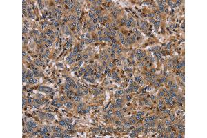 Immunohistochemistry of Human liver cancer using ETV7 Polyclonal Antibody at dilution of 1:40 (ETV7 抗体)