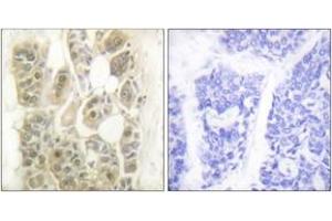 Immunohistochemistry analysis of paraffin-embedded human breast carcinoma tissue, using SSB (Ab-366) Antibody. (SSB 抗体  (AA 341-390))