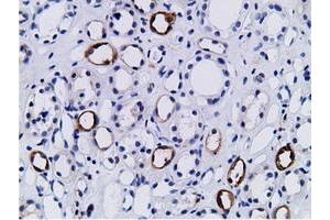 Immunohistochemical staining of paraffin-embedded Human lymphoma tissue using anti-PIK3AP1 mouse monoclonal antibody. (PIK3AP1 抗体)