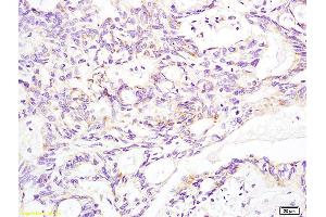 Formalin-fixed and paraffin embedded human rectal carcinoma labeled with Anti-Aldolase A Polyclonal Antibody, Unconjugated (ABIN739800) at 1:200 followed by conjugation to the secondary antibody and DAB staining (Aldolase A, Aldolase B (AA 261-364) 抗体)