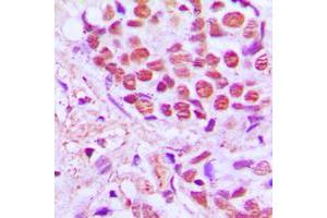 Immunohistochemical analysis of SRSF4 staining in human breast cancer formalin fixed paraffin embedded tissue section. (SRSF4 抗体  (Center))