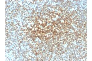 Formalin-fixed, paraffin-embedded human Follicular Lymphoma stained with Bcl-2 Mouse Recombinant Monoclonal Antibody (rBCL2/782). (Recombinant Bcl-2 抗体)
