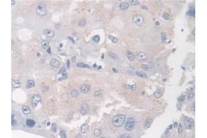 Detection of BCAR1 in Human Breast cancer Tissue using Polyclonal Antibody to Breast Cancer Anti-Estrogen Resistance 1 (BCAR1) (BCAR1 抗体  (AA 1-240))