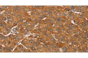 Immunohistochemistry of paraffin-embedded Human liver cancer tissue using PAGE5 Polyclonal Antibody at dilution 1:55 (PAGE5 抗体)