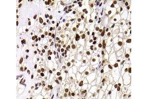 Immunohistochemistry of paraffin-embedded Human kidney cancer using PHIP Polyclonal Antibody at dilution of 1:100 (40x lens). (PHIP 抗体)