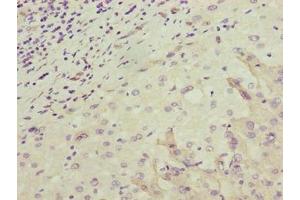 Immunohistochemistry of paraffin-embedded human liver cancer using ABIN7162175 at dilution of 1:100 (OR2H1 抗体  (AA 157-193))