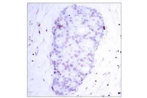 Immunohistochemical analysis of paraffin-embedded human breast carcinoma tissue using NF-κB p105/p50 (phospho-Ser907) antibody (E011019). (NFKB1 抗体  (pSer907))