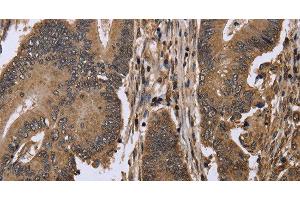 Immunohistochemistry of paraffin-embedded Human colon cancer using EIF3H Polyclonal Antibody at dilution of 1:50 (EIF3H 抗体)