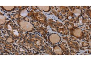 Immunohistochemistry of paraffin-embedded Human thyroid cancer using PAPPA Polyclonal Antibody at dilution of 1:50 (PAPPA 抗体)