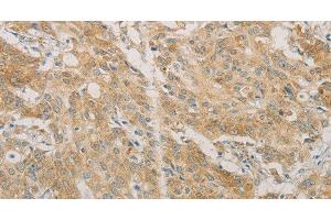 Immunohistochemistry of paraffin-embedded Human gastric cancer using ACSL4 Polyclonal Antibody at dilution of 1:60 (ACSL4 抗体)