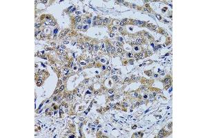 Immunohistochemistry of paraffin-embedded human colon carcinoma using TPPP3 antibody. (TPPP3 抗体  (AA 1-176))