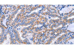 Immunohistochemistry of paraffin-embedded Human thyroid cancer using CCR6 Polyclonal Antibody at dilution of 1:50 (CCR6 抗体)