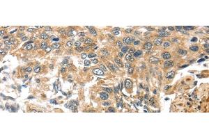 Immunohistochemistry of paraffin-embedded Human esophagus cancer tissue using TTI1 Polyclonal Antibody at dilution 1:40