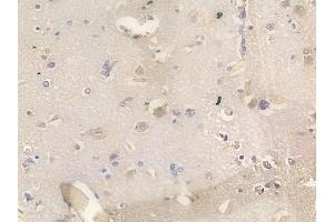 ABIN6266299 and ABIN6277447 at 1/100 staining human glioblastoma by IHC-P.