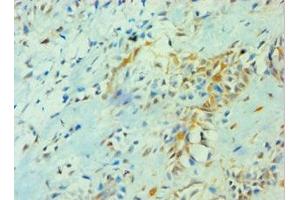 Immunohistochemistry of paraffin-embedded human breast cancer using ABIN7142103 at dilution of 1:100 (14-3-3 theta 抗体  (AA 1-245))