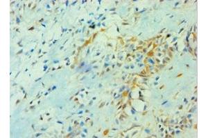 Immunohistochemistry of paraffin-embedded human breast cancer using ABIN7142103 at dilution of 1:100