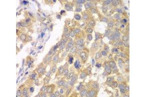 Immunohistochemistry of paraffin-embedded Human esophageal cancer using PFKM Polyclonal Antibody at dilution of 1:100 (40x lens). (PFKM 抗体)