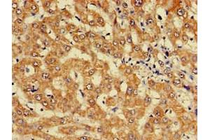 Immunohistochemistry of paraffin-embedded human liver cancer using ABIN7157603 at dilution of 1:100 (KIF17 抗体  (AA 500-777))