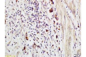 Formalin-fixed and paraffin embedded human colon carcinoma labeled with Anti-CCP Polyclonal Antibody, Unconjugated  at 1:200 followed by conjugation to the secondary antibody and DAB staining (CRYGD 抗体)