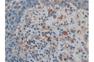 Detection of GSN in Human Skin cancer Tissue using Polyclonal Antibody to Gelsolin (GSN)