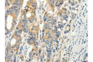 The image on the left is immunohistochemistry of paraffin-embedded Human colon cancer tissue using ABIN7130917(RPAP3 Antibody) at dilution 1/15, on the right is treated with fusion protein. (RPAP3 抗体)