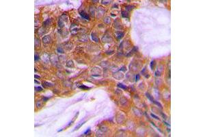 Immunohistochemical analysis of PAGE3 staining in human prostate cancer formalin fixed paraffin embedded tissue section. (PAGE3 抗体  (Center))