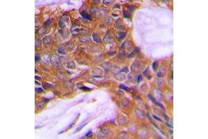 Immunohistochemical analysis of PAGE3 staining in human prostate cancer formalin fixed paraffin embedded tissue section.