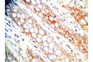 Human colon cancer tissue was stained by Rabbit Anti-CCK-33  (Human,Rat) Antibody (Cholecystokinin 抗体)