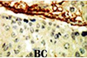 Formalin-fixed and paraffin-embedded human cancer tissue reacted with EPHA4 polyclonal antibody  , which was peroxidase-conjugated to the secondary antibody, followed by DAB staining. (EPH Receptor A4 抗体  (AA 40-70))