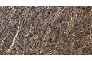 Immunohistochemistry of paraffin-embedded Human liver cancer using GSTO1 Polyclonal Antibody at dilution of 1:60 (GSTO1 抗体)