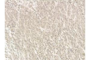 p53 Mouse Monoclonal Antibody at 1/100 staining human gastric cancer and adjacent non-tumor tissue by IHC-P. (p53 抗体  (Internal Region))