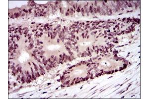 Immunohistochemical analysis of paraffin-embedded colon cancer tissues using PCNA mouse mAb with DAB staining. (PCNA 抗体  (AA 53-196))