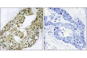 Immunohistochemistry analysis of paraffin-embedded human breast carcinoma tissue, using IkappaB-alpha (Ab-42) Antibody. (NFKBIA 抗体  (AA 9-58))