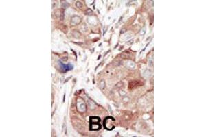 Formalin-fixed and paraffin-embedded human cancer tissue reacted with KDR polyclonal antibody  , which was peroxidase-conjugated to the secondary antibody, followed by DAB staining. (VEGFR2/CD309 抗体  (C-Term))