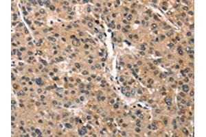 The image on the left is immunohistochemistry of paraffin-embedded Human liver cancer tissue using ABIN7190351(CRIM1 Antibody) at dilution 1/25, on the right is treated with synthetic peptide. (CRIM1 抗体)