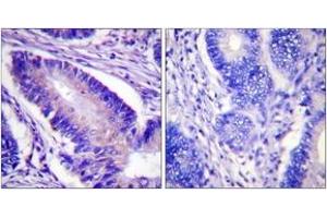Immunohistochemistry analysis of paraffin-embedded human colon carcinoma, using eIF4B (Phospho-Ser422) Antibody. (EIF4B 抗体  (pSer422))