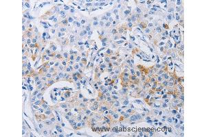 Immunohistochemistry of Human lung cancer using LRIG1 Polyclonal Antibody at dilution of 1:120 (Lrig1 抗体)