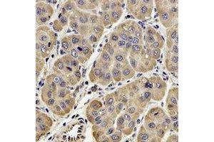 Immunohistochemical analysis of GPx-4 staining in human liver cancer formalin fixed paraffin embedded tissue section. (GPX4 抗体)