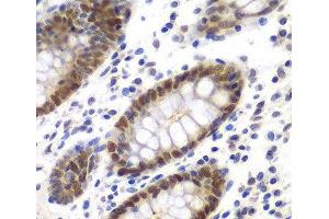 Immunohistochemistry of paraffin-embedded Human colon using MSH6 Polyclonal Antibody at dilution of 1:100 (40x lens). (MSH6 抗体)