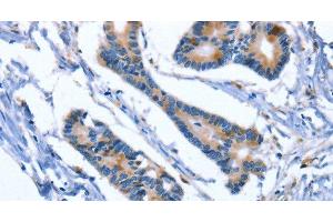 Immunohistochemistry of paraffin-embedded Human colon cancer using IBSP Polyclonal Antibody at dilution of 1:50 (IBSP 抗体)