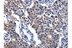 The image on the left is immunohistochemistry of paraffin-embedded Human lung cancer tissue using ABIN7130344(NAT8 Antibody) at dilution 1/50, on the right is treated with fusion protein. (NAT8 抗体)
