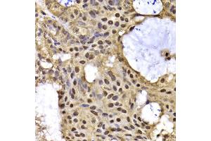 Immunohistochemistry of paraffin-embedded human oophoroma using ARID3A antibody (ABIN5975618) at dilution of 1/100 (40x lens). (ARID3A 抗体)